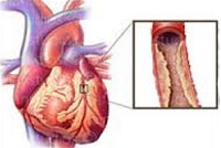 Атеросклеротический кардиосклероз0